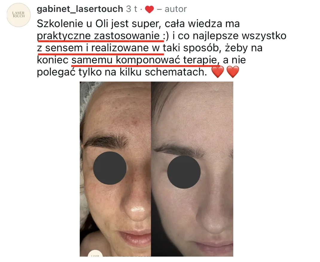 Opinia Agnieszki i efekty przed i po